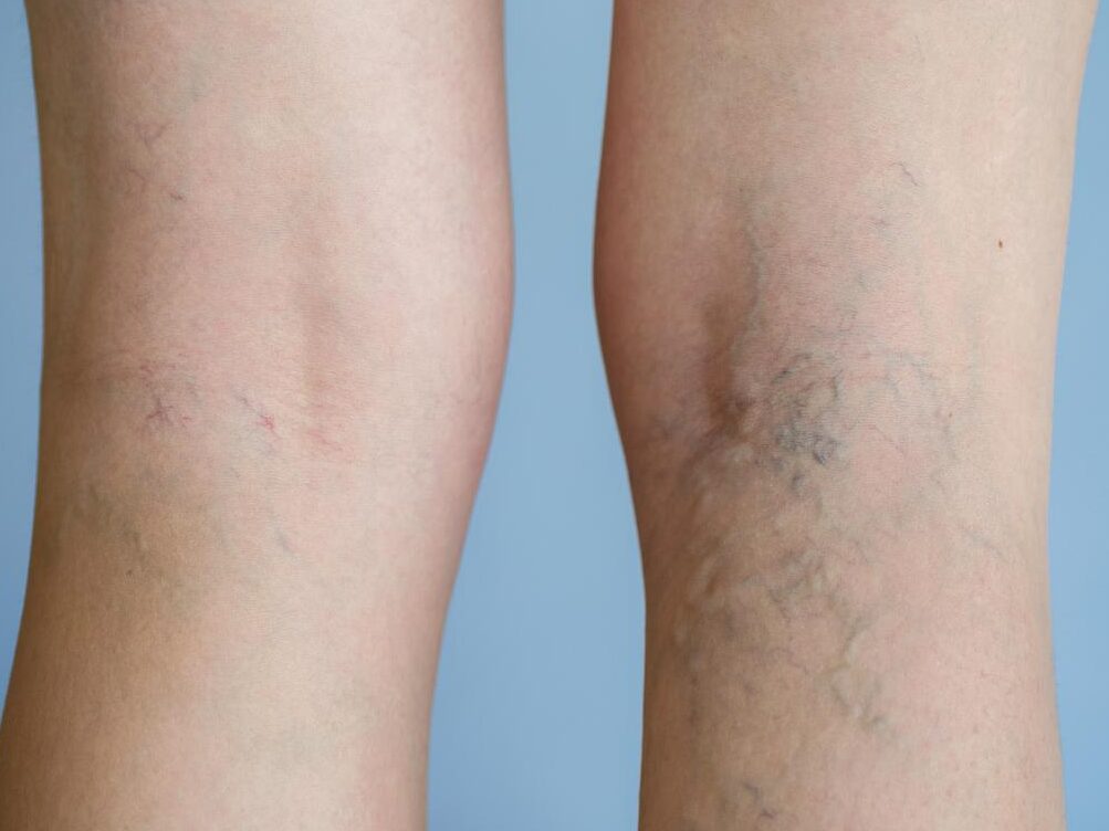 Comment traiter naturellement les varicosités ?